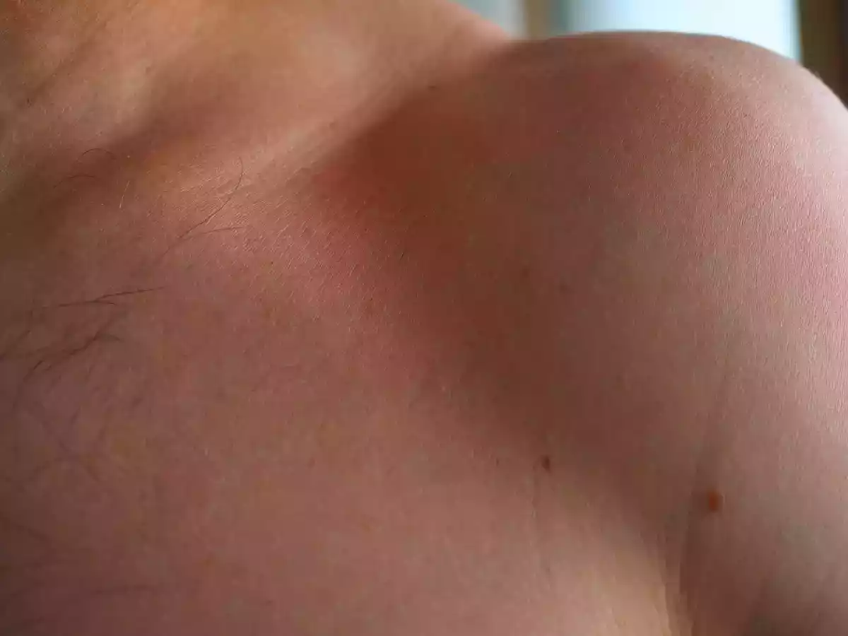 14. Irritações na pele